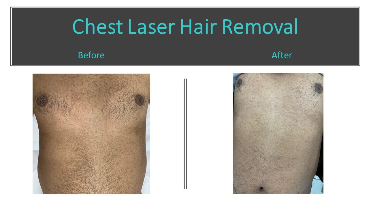 laserhairremoval Enamour Hair & Body Clinic