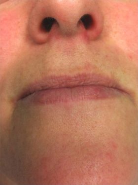 Face After