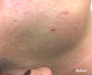 LaserHR_Face_B&A_01