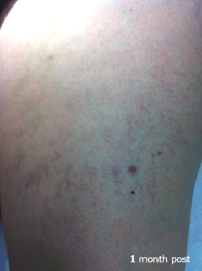 Vascular_B&A_0002_1mth post Vascular_B&A_0002_1mth post