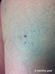 Vascular_B&A_0003_2mth post Vascular_B&A_0003_2mth post